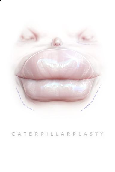 Caterpillarplasty poster